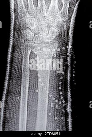 Colles fracture cicatrisation d'une vieille femelle, un type de fracture de l'avant-bras distal, l'extrémité cassée du RADIUS est pliée vers l'arrière, à la suite d'un f Banque D'Images