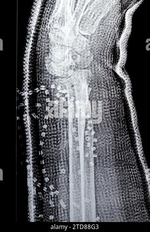 Colles fracture cicatrisation d'une vieille femelle, un type de fracture de l'avant-bras distal, l'extrémité cassée du RADIUS est pliée vers l'arrière, à la suite d'un f Banque D'Images