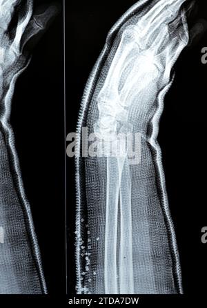 Réduction de fracture colles d'une vieille femelle, un type de fracture de l'avant-bras distal, l'extrémité cassée du RADIUS est pliée vers l'arrière, à la suite d'un Banque D'Images