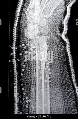 Colles fracture cicatrisation d'une vieille femelle, un type de fracture de l'avant-bras distal, l'extrémité cassée du RADIUS est pliée vers l'arrière, à la suite d'un f Banque D'Images