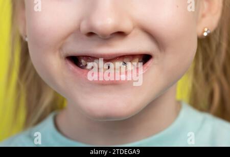 Bouche souriante d'une fille avec des molaires de croissance inégale et des dents de bébé. Dentisterie pédiatrique, gros plan. Banque D'Images