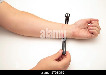 Irritation, rougeur et démangeaisons sur la peau après avoir porté une montre ou un bracelet fitness. Allergie au bracelet de montre, dermatite de contact. Banque D'Images