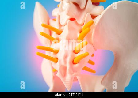 Modèle de la colonne vertébrale humaine, section du coccyx enflammé avec nerfs sur fond bleu. Nerf pincé en raison de problèmes avec la colonne vertébrale. Spondylolisth Banque D'Images