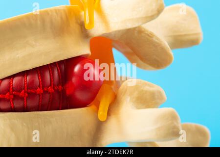 Hernie discale rouge convexe sur un modèle de rachis. Traitement des problèmes et maladies du rachis. Orthopédie et vertébrologie. Banque D'Images