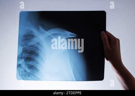 La main d'une femme tient une radiographie d'un patient avec une épaule disloquée et une clavicule fracturée, ostéoporose. Chirurgie de reconstruction de l'épaule JO Banque D'Images