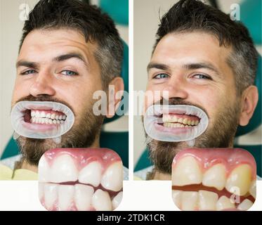 Blanchiment après et avant. Homme en fauteuil dentaire. Dentiste préparant pour le blanchiment dentaire. Médecine de la santé personnes dentisterie médecin curant. Résultat de Banque D'Images