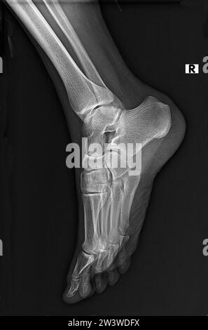 Radiographie normale, radiographie ou radiographie de l'articulation du pied et de la cheville en projection latérale, traumatologie et orthopédie, rhumatologie Banque D'Images