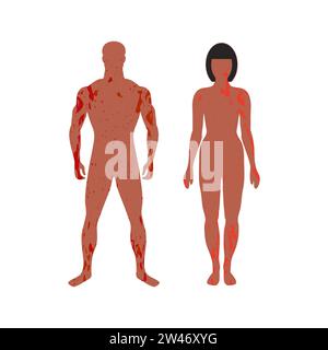 Homme et femme avec éruption cutanée douloureuse. Les taches recouvrent leur corps entier. Maladie de la peau ou trouble de la pigmentation. Silhouettes de patients. Méningite ou dermatite Illustration de Vecteur