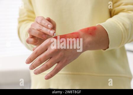 Femme appliquant la crème de guérison sur la main brûlée à l'intérieur, closeup Banque D'Images