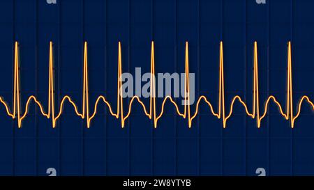 Flutter auriculaire rythme cardiaque anormal, illustration Banque D'Images
