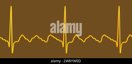 Flutter auriculaire rythme cardiaque anormal, illustration Banque D'Images