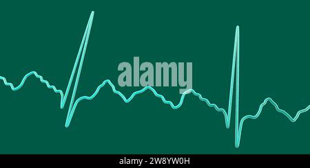 Flutter auriculaire rythme cardiaque anormal, illustration Banque D'Images