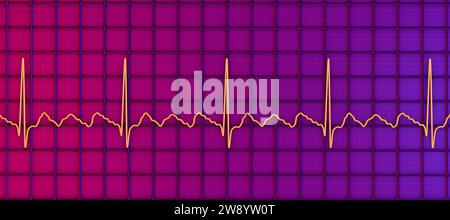 Flutter auriculaire rythme cardiaque anormal, illustration Banque D'Images