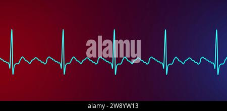 Flutter auriculaire rythme cardiaque anormal, illustration Banque D'Images