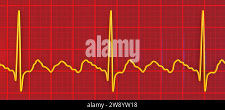 Flutter auriculaire rythme cardiaque anormal, illustration Banque D'Images