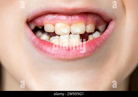 Pas de dents. Dents jaunes. Mauvaise santé dentaire, pas de dents, pas de fluor, érosion dentaire. Portrait garçon avec de mauvaises dents. Les mauvaises dents de l'enfant. Le garçon a perdu l'avant Banque D'Images