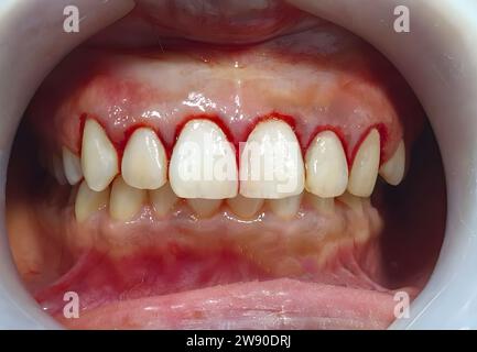 Saignement gingival dans la mâchoire supérieure. Vue en gros plan Banque D'Images