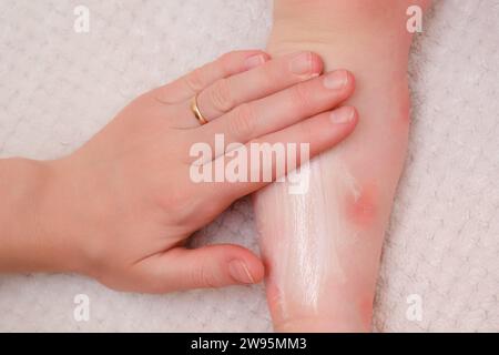 Soins de la peau, allergies et dermatites pour tout-petits. Une mère-femme sourit des taches rouges d'allergie et de dermatite atopique sur la peau de l'enfant avec de la crème. Enfant A. Banque D'Images