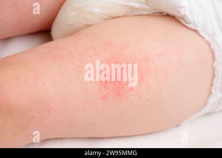 Éruption allergique sur les jambes du bébé garçon en bas âge. Boutons rouges des allergies sur le corps de l'enfant. Banque D'Images