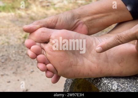 La main de la femme pointe vers le mal de pied causé par le pied de l'athlète. Le patient souffre d'une maladie grave de la peau du pied. Photo rapprochée de la maladie du pied Banque D'Images