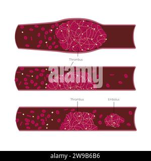 Différents types de thrombus et d'emboles dans les vaisseaux sanguins illustration du closup. Dossier médical pour la science ou l'éducation. Illustration vectorielle Illustration de Vecteur