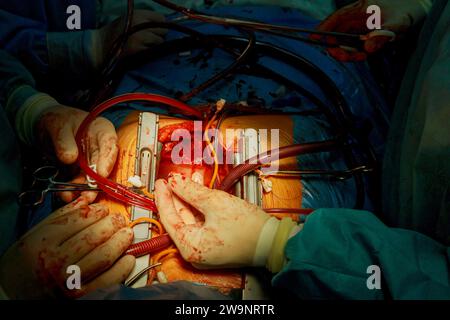 Au cours d'une intervention chirurgicale pour retirer une valvule aortique transcathéter expansible à coeur ouvert Banque D'Images