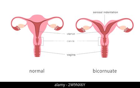 Structure bicorne et normale de l'utérus humain. Septum utérin profond comme malformation utérine congénitale. Diagramme anatomique. Illustration de Vecteur