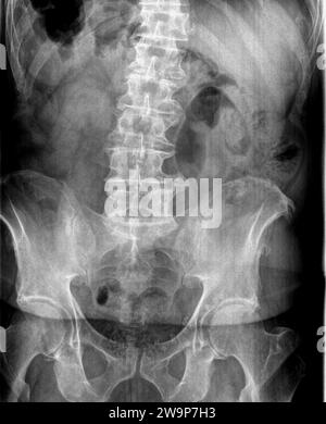 Radiographie ou radiographie d'une vue AP antérieure postérieure de vertèbres lombaires adultes montrant un très grand éperon osseux ostéophyte sur la traverse droite L4 L5 Banque D'Images