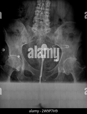 Radiographie ou radiographie d'une vue AP antérieure postérieure de vertèbres lombaires adultes normales montrant une structure osseuse normale avec de nombreux artefacts métalliques détectés Banque D'Images