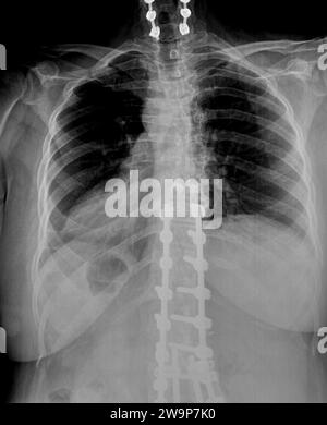 Radiographie ou radiographie d'une partie médiane du dos thoracique et des vertèbres cervicales vue postérieure antérieure montrant un support chirurgical pour aider à stabiliser les patients Banque D'Images