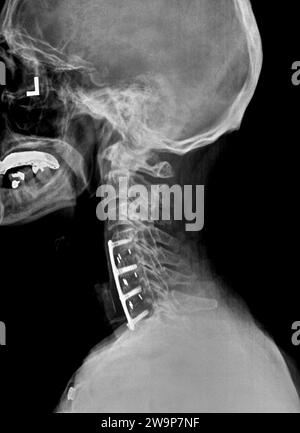 Radiographie ou radiographie filmique d'un col cervical. Vue latérale montrant le support chirurgical pour aider à stabiliser le cou du patient Banque D'Images