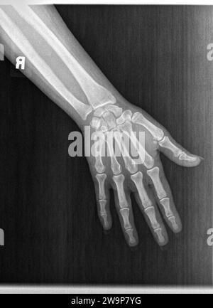 Radiographie de film ou radiographie d'une main gauche normale d'un homme adulte. La vue AP montre la main de l'homme. structure osseuse normale de toutes les phalanges os carpiens métacariens Banque D'Images