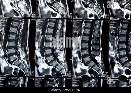 Le Caire, Egypte, décembre 24 2023 : preuve de laminectomie spinale des vertèbres L5, décompression du sac thécal postérieur, spondylose lombaire, protr discal postérieur Banque D'Images