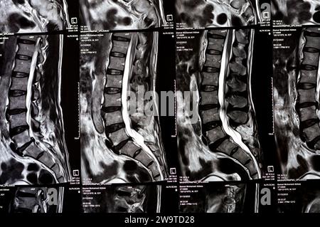 Le Caire, Egypte, décembre 24 2023 : preuve de laminectomie spinale des vertèbres L5, décompression du sac thécal postérieur, spondylose lombaire, protr discal postérieur Banque D'Images