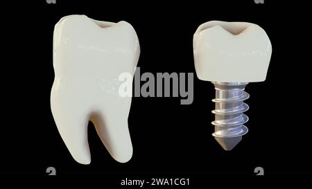 rendu 3d de dent humaine saine et implant dentaire dans le fond noir Banque D'Images