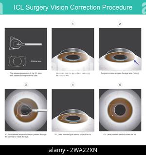 Procédure de correction de la vision en chirurgie ICL. Une nouvelle lentille oculaire qui peut être implantée dans l'œil sans retirer la lentille naturelle. Illustration de Vecteur