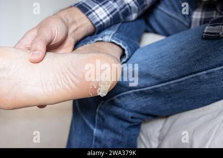 Peau de boursouflure cassée et sèche sur le pied Banque D'Images