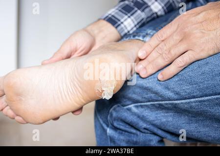 Peau de boursouflure cassée et sèche sur le pied Banque D'Images