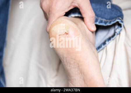 Peau de boursouflure cassée et sèche sur le pied Banque D'Images