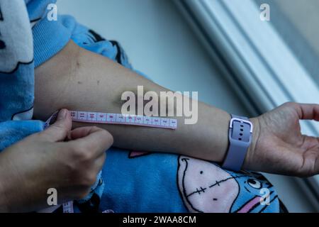 Ecchymoses de canule dans l'avant-bras Banque D'Images