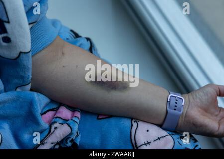 Ecchymoses de canule dans l'avant-bras Banque D'Images