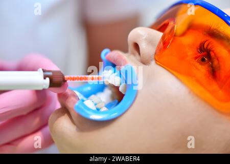 Dentiste applique le gel blanchissant sur les dents du patient. Le blanchiment des dents dans un concept de clinique dentaire. Gros plan Banque D'Images