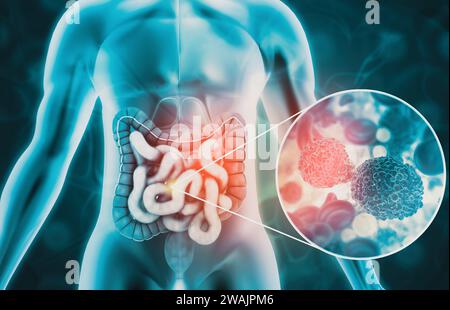 Anatomie du corps humain. Cancer du côlon, concept de maladie du côlon, 3d illustration Banque D'Images