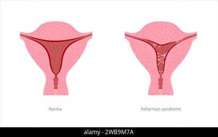 Syndrome d'Asherman appareil reproducteur féminin. Section transversale de l'utérus avec cendres. Tissu cicatriciel dans la cavité utérine et organe sain normal. Illustration de Vecteur