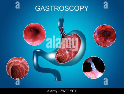 Endoscopie digestive ou gastroscopie. Exécution d'une procédure de gastroscopie. Diagnostic des maladies gastriques. Santé de l'estomac. Concept médical Banque D'Images