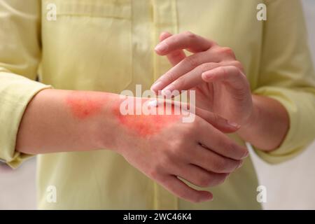 Femme appliquant la crème de guérison sur la main brûlée à l'intérieur, closeup Banque D'Images