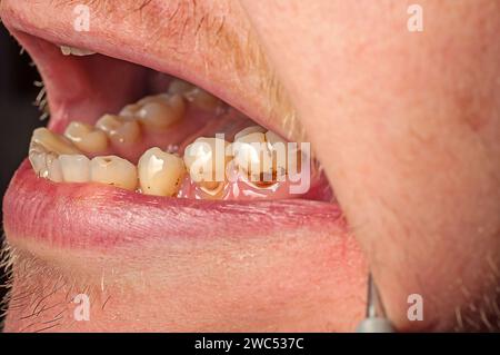 Gros plan de dents brunes avec plaque et caries. L'obturation est tombée de la dent Banque D'Images