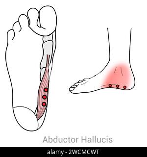 Abductor Hallucis : points déclencheurs myofasciaux et localisations douloureuses associées Banque D'Images