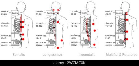 Muscles spinaux profonds : points déclencheurs myofasciaux et localisations douloureuses associées Banque D'Images