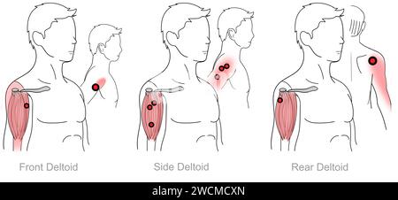 Deltoïdes : points déclencheurs myofasciaux et localisations douloureuses associées Banque D'Images